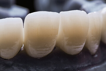 dental prosthetics veneers implant