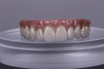 dental prosthetics veneers implant