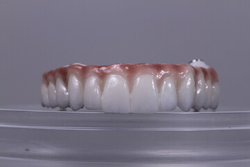 dental prosthetics veneers implant