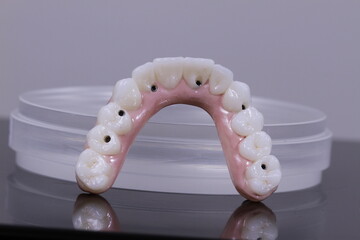 dental prosthetics veneers implant