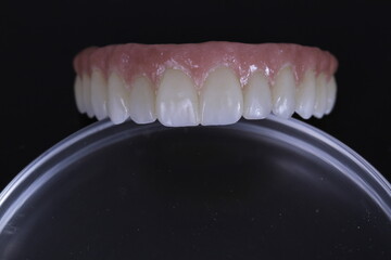 dental prosthetics veneers implant