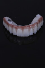dental prosthetics veneers implant