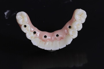 dental prosthetics veneers implant