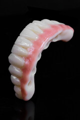 dental prosthesis veneers implant