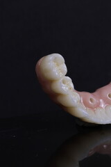 dental prosthesis veneers implant