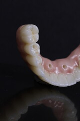 dental prosthesis veneers implant
