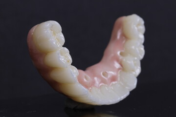 dental prosthesis veneers implant