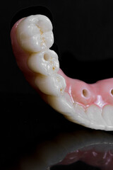 dental prosthesis veneers implant