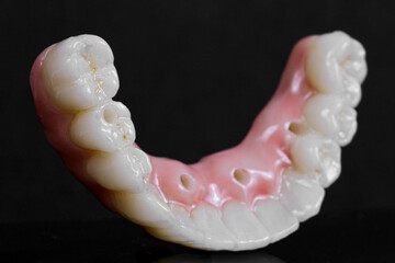 dental prosthesis veneers implant