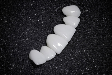 dental prosthesis veneers implant