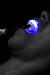 dental prosthesis veneers implant
