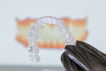 dental prosthesis veneers implant