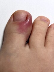 Ingrown toenails with inflammation on the toenails due to bacteria causing inflammation. 