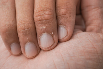 Dry and peeling skin under the fingernails, which may be caused by dry skin, dehydration, and a deficiency of nutritional vitamins or minerals. Isolated on white background
