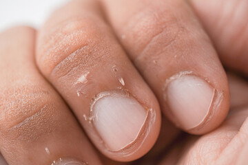 Dry and peeling skin under the fingernails, which may be caused by dry skin, dehydration, and a deficiency of nutritional vitamins or minerals. Isolated on white background