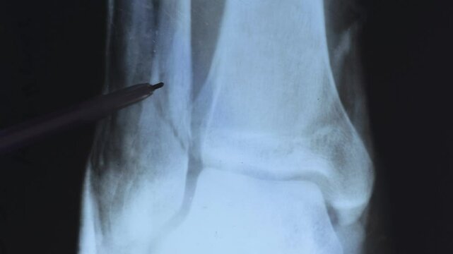 Doctor learning X-ray scan of a brokening fibula bone. 4k footage.