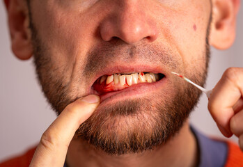 Man Holding Dental Rubber Toothpick Showing Bleeding Gums, Gum Disease Caused by Poor Oral Hygiene
