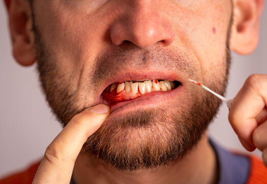 Man Holding Dental Rubber Toothpick Showing Bleeding Gums, Gum Disease Caused by Poor Oral Hygiene