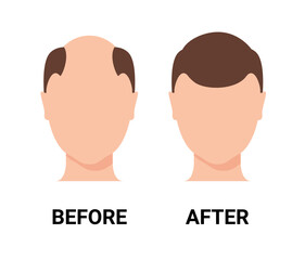 Hair loss man icon cartoon vector logo. Hair loss male scalp bald illustration