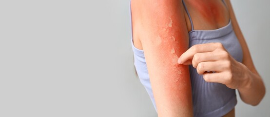 Woman with red sunburned skin against grey background with space for text, closeup