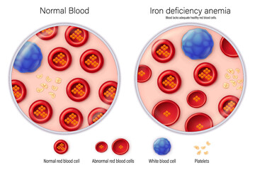 Comparison between normal blood and iron deficiency anemia vector. Blood smear. Medical education.