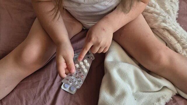 A child with a chickenpox rash holds a plate of chickenpox pills in his hands.