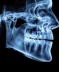 X ray image of human jaw showcasing dental implants, highlighting dental health and anatomy. clarity of image emphasizes structure of teeth and jaw