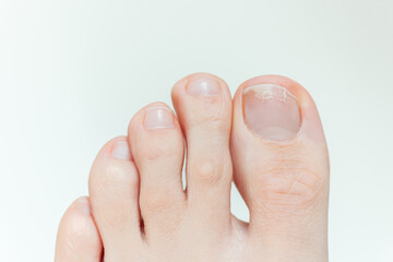 A close-up shot of a young woman's layered toenails. Lack of vitamins and minerals in the human body. Dermatology