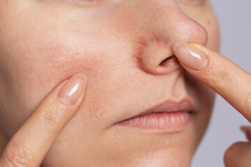 Close-up young Caucasian woman showing redness and inflamed blood vessels on her nose. 