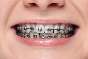 Woman with braces on her teeth is smiling. Metal bracket system on the teeth of a young woman....