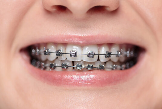 Woman with braces on her teeth is smiling. Metal bracket system on the teeth of a young woman. Shallow depth of field.