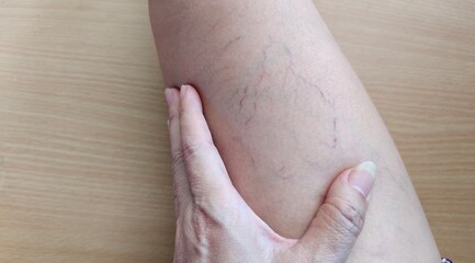 close up the varicose veins spider lines, problem circulation of blood on the leg of the woman, health care and medical concept.