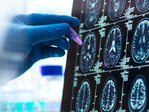 Dementia and Alzhiemer's Research, Scientist preparing human sample during a clinical trial