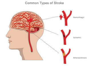 Illustration of common types of brain stroke, including ischemic, hemorrhagic, and transient ischemic attack, highlighting causes, effects, and impact on brain function