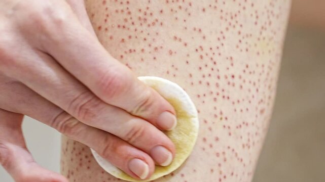 Treatment of the skin on the legs after electrolysis with a cotton pad soaked in an alcoholic solution of calendula