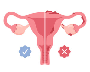 Uterus with endometriosis infographic in flat style.