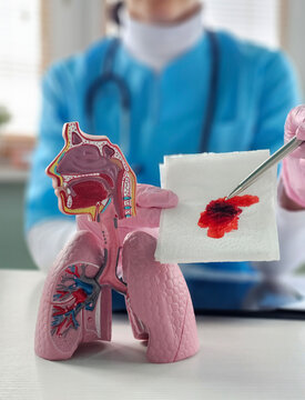 Pulmonary hemorrhage causes symptoms, diagnosis