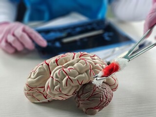 Cerebral circulatory disorder. Surgery for cerebral stroke