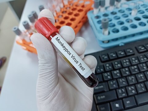  Lab Technologist hold blood sample for Monkeypox  test. Laboratory medical testing concept. 