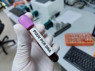 Lab Technologist hold blood sample for PCR HCV RNA test. Laboratory medical testing concept. 