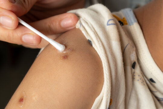 A mother applies skin ointment to her child's hand on a bug bite mark using a cotton bud