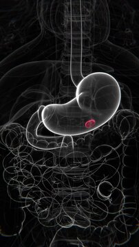 Peptic Ulcers Indication Video | Ulcers in stomach in Vertical HQ Video