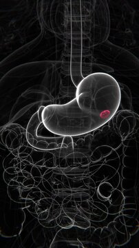 Peptic Ulcer Indication Video in HQ | Stomach Ulcers in Vertical HD Video