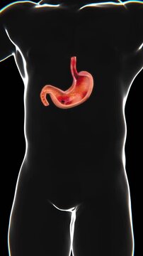Peptic Ulcers Indication Video | Multiple Ulcers in stomach in Vertical HQ Video