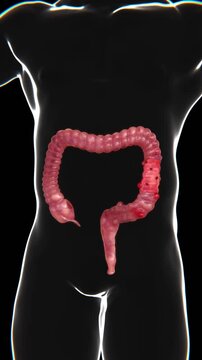 Diverticulitis Indication X-ray in Vertical Video | Diverticulitis X-ray in Vertical HQ Video