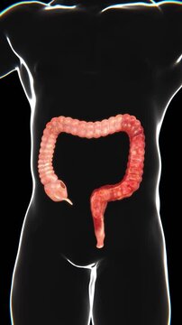Ulcerative Colitis Indication Video | Ulcerative Colitis in Vertical HQ Video