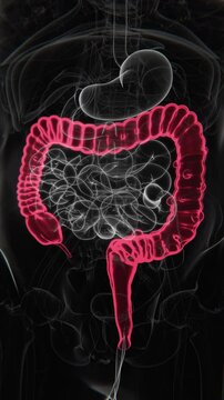 Diverticulitis Indication X-ray in Vertical Video | Diverticulitis X-ray in Vertical HQ Video