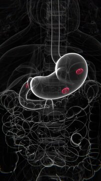 Peptic Ulcers and Duodenal Ulcers Indication Video | Multiple Ulcers in stomach in Vertical HQ Video