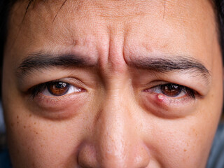 Fototapeta premium Close Up of Adult Man with one eye infection, Chalazion, Stye (hordeolum) on eyelid.