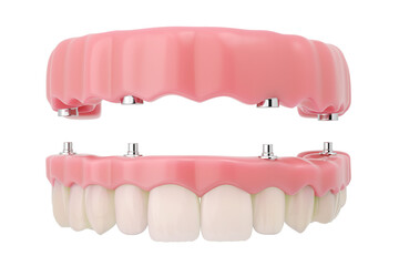 full mouth dental implant with screw-supported denture, Front view.